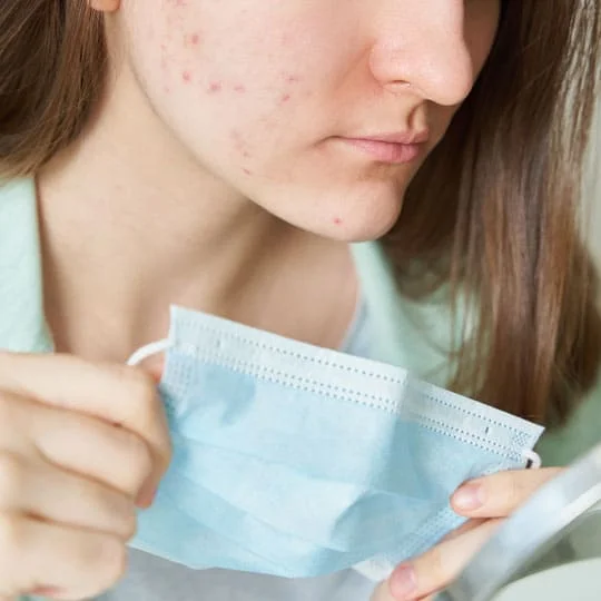 Acne Treatment in Noida, Acne Treatment Clinic in Noida